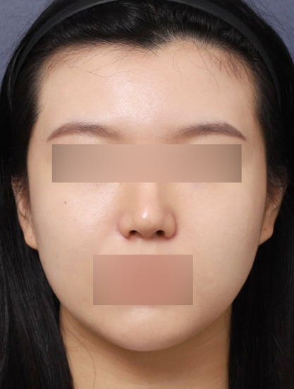 복코재수술(1개월 차) 3_수정2.png