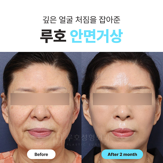 안면거상1_국문 복사.jpg