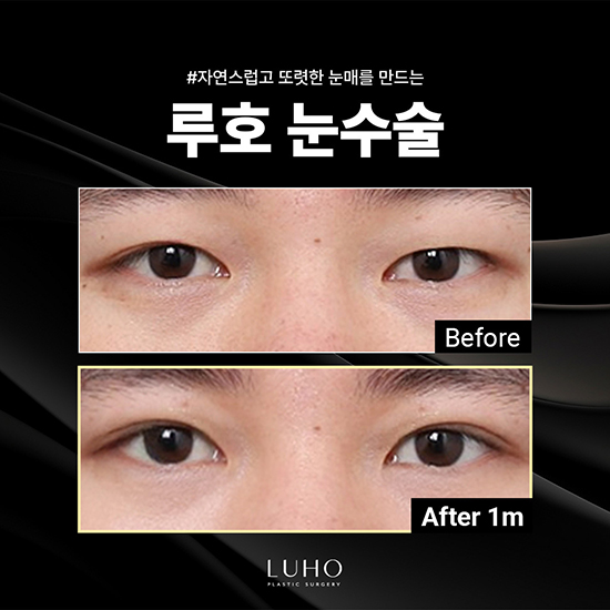 눈수술1_국문 복사.jpg
