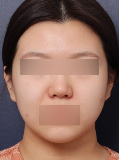 복코재수술(1개월 차) 3_수정1.png