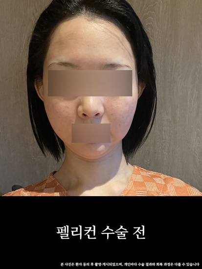 수술전1 copy.jpg