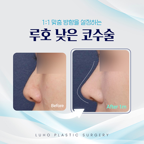 낮은코수술4_국문 복사.jpg
