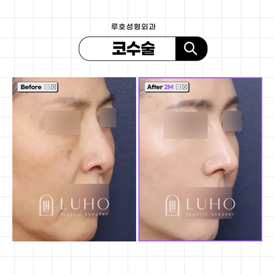 긴코성형.jpg