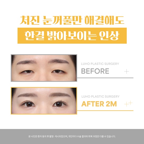 눈성형1_국문.jpg