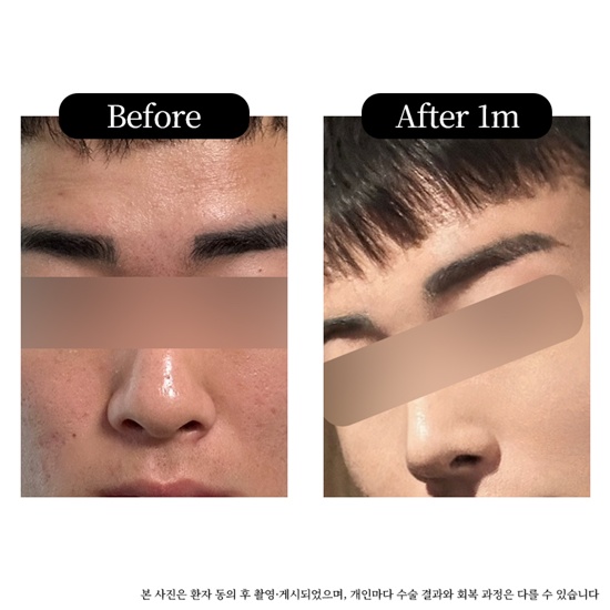 전-후(1달차).jpg