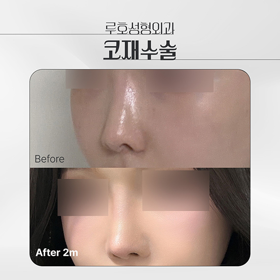 코재수술1_국문 복사.jpg