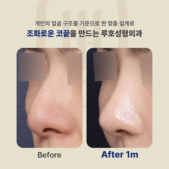 코끝성형4_국문 복사.jpg
