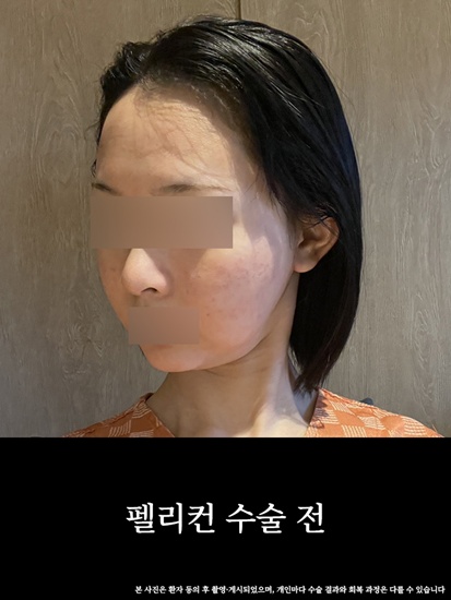 수술전2 copy.jpg