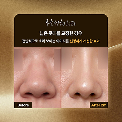 코수술1_국문 복사.jpg