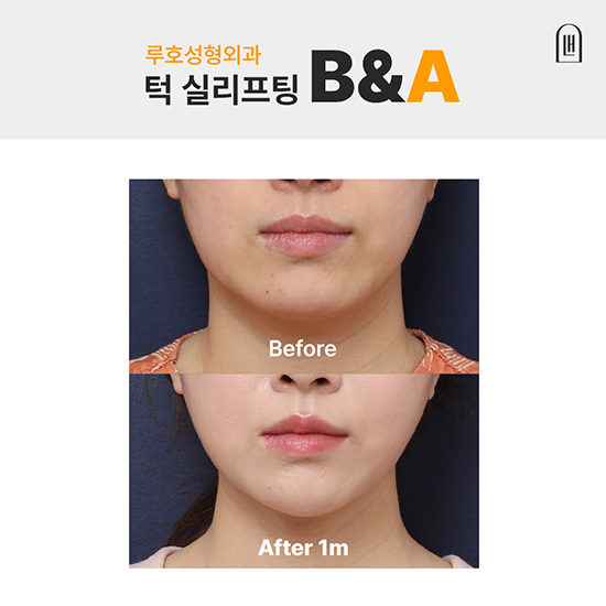 실리프팅1_국문 복사.jpg