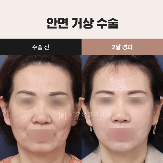 안면거상_국문.jpg