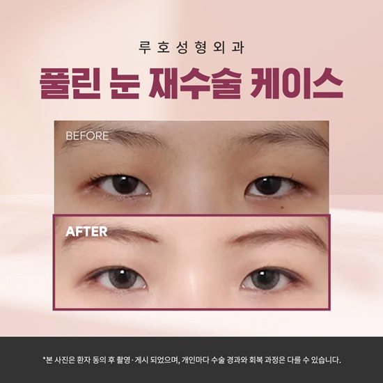 눈성형1_국문.jpg