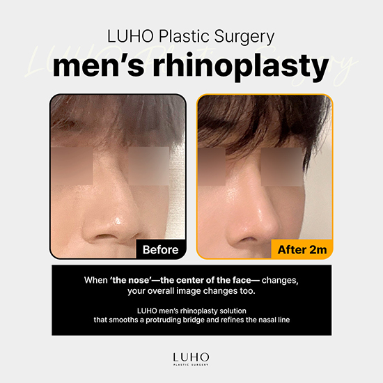남자코성형_영문 복사.jpg