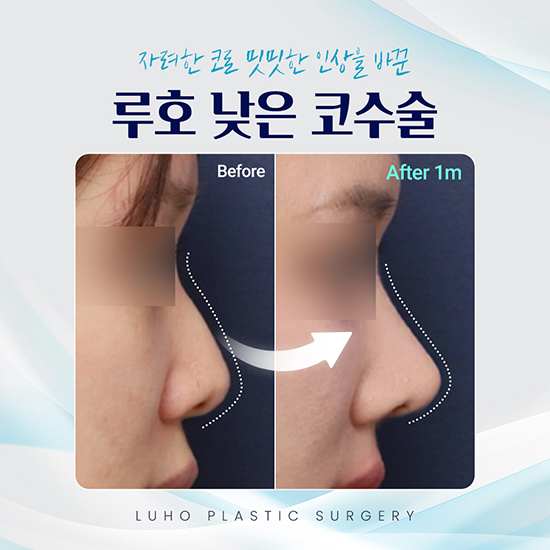낮은코수술1_국문 복사.jpg