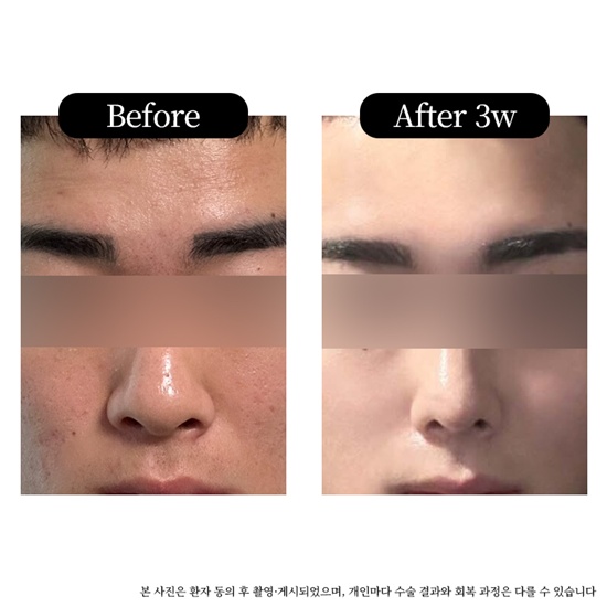 전-후(3주차).jpg